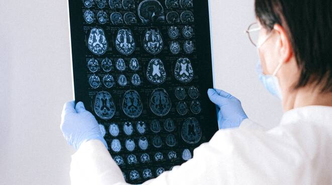 Giornata Alzheimer: una (possibile) origine comune per 3 malattie neurodegenerative